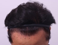 [남성탈모] 루트의원 6개월 | 모발이식 후기, 리뷰, 비용은 대다모!