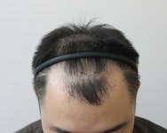 [남성탈모] 루트의원 비절개 모발이식 후기 | 모발이식 후기, 리뷰, 비용은 대다모!