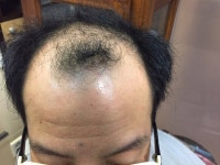 [남성탈모/기타] 모빈치에서 비절개로 수술 받고 왔습니다. | 모발이식 후기, 리뷰, 비용은 대다모!