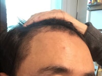 [모션모발이식의원] 모션 헤어라인 1500모낭 이식 후 60일 | 모발이식 후기, 리뷰, 비용은 대다모!