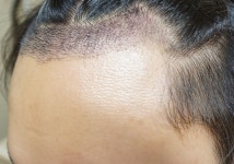 [뉴헤어모발성형외과의원] 남자 M 헤어라인 1300모낭 10일쨰 수술후기입니다. | 모발이식 후기, 리뷰, 비용은 대다모!