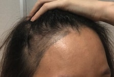 [뉴헤어] 저 헤어라인 이틀됫어요!!!행복해요 ㅠ 어떤지 좀 봐주세요! | 모발이식 후기,리뷰,비용은 대다모!