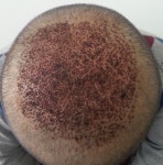 [모재성] 비절개수술했어요 모재성성형외과 2500모낭 | 모발이식후기, 모발이식추천은 대다모!