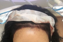 [뉴헤어모발성형외과의원] 헤어라인수술했어요~ | 모발이식 후기, 리뷰, 비용은 대다모!