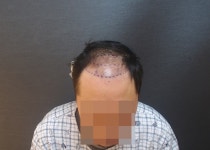 [남성탈모] 모힐의원 5000모 이식 9개월차 평가입니다(절개) | 모발이식 후기, 리뷰, 비용은 대다모!