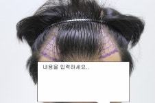 포헤어 수술 1년 경과 사진 포헤어수술1년경과사진