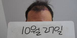 [남성탈모/기타] [대전] 연세모벨르 4500모 절개 5개월차 후기 남깁니다 -ㅎ | 모발이식 후기, 리뷰, 비용은 대다모!