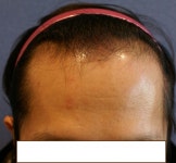 [모션모발이식의원] 모션에서 헤어라인 1400모낭 후기 | 모발이식 후기, 리뷰, 비용은 대다모!