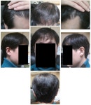 강남 ㅁㅅ M자 1800모낭 275일차~ 강남ㅁㅅM자1800모낭275일차