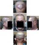 강남 ㅁㅅ M자 1800모낭 1일차~ | 모발이식 후기,리뷰,비용은 대다모!