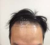 [뉴헤어모발성형외과의원] 뉴헤어 2000모낭 비절개 1년 9개월 후 후기.... [뉴헤어모발성형외과의원] 뉴헤어 2000모낭 비절개 1년 9개월 후... 