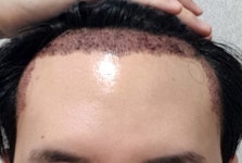 NHI뉴헤어 비절개 1800모낭 3일차 후기 NHI뉴헤어비절개1800모낭3일차후기