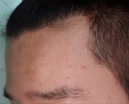 [뉴헤어] 뉴헤어 비절개 1300모낭 197일(약 6개월) 경과 후기입니다. | 모발이식 후기,리뷰,비용은 대다모!