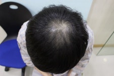 [Cham Doctor Clinic] 정수리 비절개2500 5개월 | 植毛の体験談、レビュー、費用なら DAEDAMO！