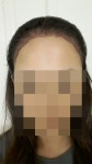 [다나성형외과] 드디어 다나에서 헤어라인 완료(2일차) | 모발이식 후기, 리뷰, 비용은 대다모!