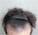 M자 이식 후… 암흑기와 싸우는 중이예요ㅎㅎ M자이식후…암흑기와싸우는중이예요ㅎㅎ