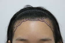 [모스트모발이식센터] 헤어라인 교정 했어요~ | 모발이식 후기, 리뷰, 비용은 대다모!