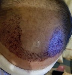 [한나이브모발이식센터] 한나이브 비절개 하고 왔어요 | 모발이식 후기, 리뷰, 비용은 대다모!