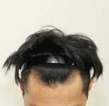 [뉴헤어모발성형외과의원] 시술 직후 사진 및 평가입니다. | 모발이식 후기, 리뷰, 비용은 대다모!