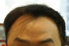 [모션모발이식의원] 모션 1600모낭 모발이식 사진 | 모발이식 후기, 리뷰, 비용은 대다모!