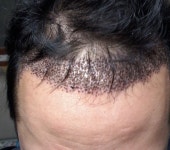 [남성탈모] 노블라인의원에서 3000모 이식 2주차네요. | 모발이식 후기, 리뷰, 비용은 대다모!