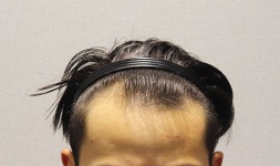 [모플러스성형외과] 모플러스 성형외과에서 m자 2700모(+100) 심은 후기 | 모발이식 후기, 리뷰, 비용은 대다모!