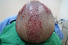 [모션모발이식의원] 엠자 정수리 1200모낭 11개월 정수리 평가 | 모발이식 후기, 리뷰, 비용은 대다모!