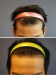 모션!!!  비절개 무삭발 800모낭 일년 경과 후기입니다 모션비절개무삭발800모낭일년경과후기입니다