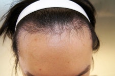 [모션모발이식의원] 모션 1300모낭 수술 4개월 경과 더 심해진 암흑기.. | 모발이식 후기, 리뷰, 비용은 대다모!