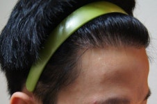 강남 모션 2차 추가 수술 9개월 경과 후기 강남모션2차추가수술9개월경과후기