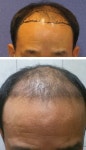 [모션모발이식의원] 모션 2000모낭 10개월 이식 경과 사진 후기입니다 | 모발이식 후기, 리뷰, 비용은 대다모!