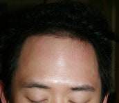 저도 3개월 경과 공유해요 저도3개월경과공유해요