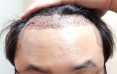 [뉴헤어모발성형외과의원] 디자인&밀도 평가부탁드립니다. 뉴헤어 비절개 1900모낭 | 모발이식 후기, 리뷰, 비용은 대다모!