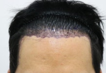 [Most Clinic] Most Reoperation | Hair transplant reviews, stories, and costs — all on DAEDAMO!