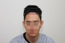 [뉴헤어모발성형외과의원] 1년경과입니다아 ~ ~ | 모발이식 후기, 리뷰, 비용은 대다모!