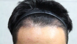 [한나이브모발이식센터] M자탈모 2800모 3개월이 지났습니다 | 모발이식 후기, 리뷰, 비용은 대다모!