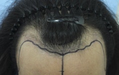 [한나이브모발이식센터] 이식한지 1년이 훌쩍 지나가 버렸어요 | 모발이식 후기, 리뷰, 비용은 대다모!