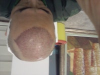 [남성탈모] 터키 메디칼 파크에서 수술한지3일차 입니다 | 모발이식 후기, 리뷰, 비용은 대다모!