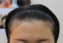 [女性型脱毛症] ドリームヘアラインでヘアライン矯正しました~ | 植毛の体験談、レビュー、費用なら DAEDAMO！