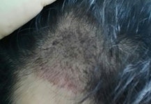 모션!!! 1개월차 수술 경과 보고 모션1개월차수술경과보고