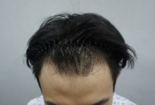 [모플러스성형외과] 모플러스 M자 비절개 10개월 후기 | 모발이식 후기, 리뷰, 비용은 대다모!