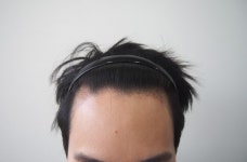 [모재성모발이식센터] [모재성성형외과] 2300모 비절개 수술 12개월 포토후기 | 모발이식 후기, 리뷰, 비용은 대다모!