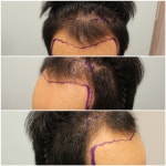 [남성탈모] 이식후 후기사진 올립니다 | 모발이식 후기, 리뷰, 비용은 대다모!