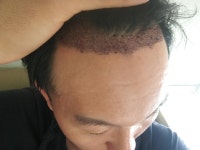 양경애헤어２０００ | [뉴헤어모발성형외과의원] 뉴헤어 2000모낭 이식했어용 봐주세용 3일차 | 모발이식 후기, 리뷰, 비용은 대다모!