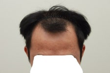 [남성탈모] 닥터안 헤어플란트 모발이식 평가 올립니다. | 모발이식 후기, 리뷰, 비용은 대다모!