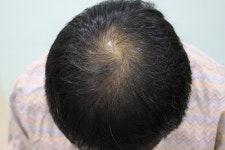 [남성탈모] 참닥터의원, 정수리 6개월 지났네요.두번째후기. | 모발이식 후기, 리뷰, 비용은 대다모!