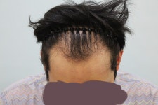 [남성탈모] 참닥터, 2016년. 라인~정수리숱보강, 비절개4800모,3년경과~ | 모발이식 후기, 리뷰, 비용은 대다모!