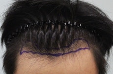 [참닥터모발이식의원] 모발이식 헤어라인m자 2년사진후기 (참닥터) | 모발이식 후기, 리뷰, 비용은 대다모!