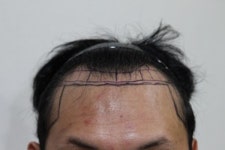 [뉴헤어모발성형외과의원] 뉴헤어에서 수술받았는데 | 모발이식 후기, 리뷰, 비용은 대다모!