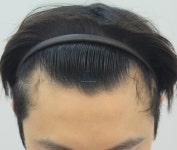 [포헤어 비절개모발이식센터] 포헤어 1289모낭 수술하고 3주됐는데 질문 있습니다 | 모발이식 후기, 리뷰, 비용은 대다모!